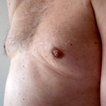 Alle Artikel dieser Kategorie -> Gynäkomastie  Brustdrüsenentfernung  beim Mann
